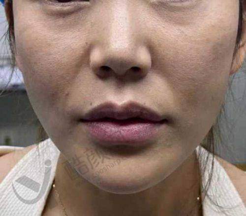 鼻基底填充选啥材料好？玻尿酸填充优势揭秘